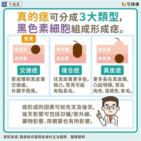 臉上的痣長毛|是痣？皮膚癌？還是什麼？常見Q&A解惑！醫教揪出「。